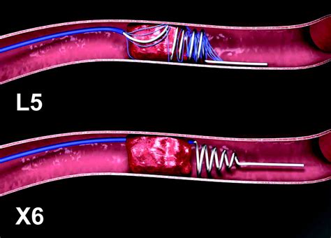 Mechanical Thrombectomy Stroke