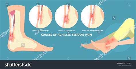 Achilles Tendon Rupture Injury Feet Calf Stock Vector Royalty Free