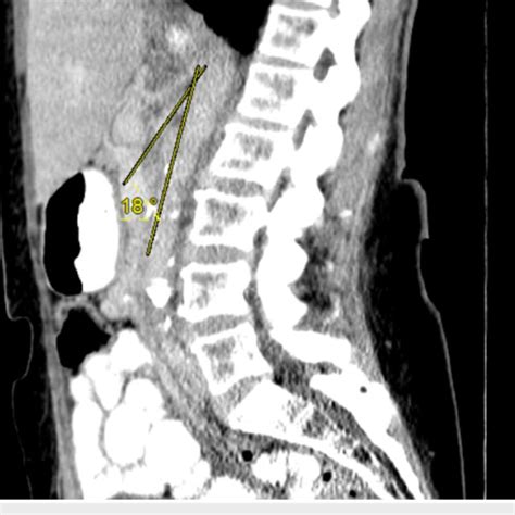 Sagittal Ct Scan Of The Abdomenpelvis With Oral And Intravenous Download Scientific Diagram