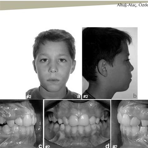 Intermediate Phase Of Treatment A Facial Frontal B Facial Lateral