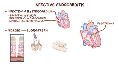 Pathophysiology Of Endocarditis