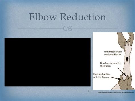 Improving Orthopedic Elbow Reduction Techniques through Clinical Simu…