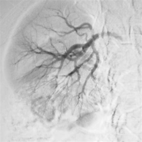 Right Renal Arteriography Following Selective Embolization Of The Upper