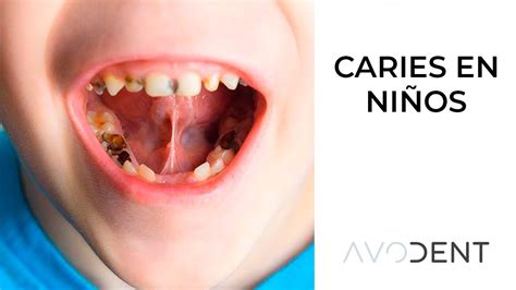 Cómo evitar la caries en los niños Cuál es su tratamiento Clínica