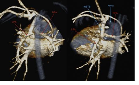 Figure 3 From Diagnosis And Follow Up Of Neonatal Tetralogy Of Fallot