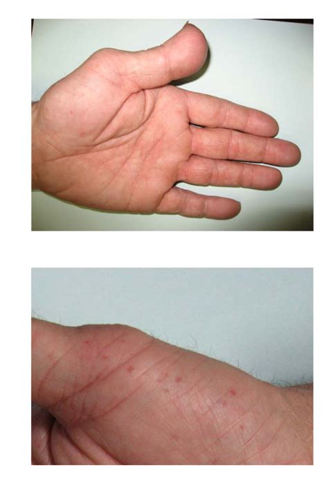 Patients Hands A Left Hand Broad Thumb Mild Brachydactyly Palmar