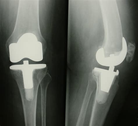 Arthroplastie Par Prothèse De Genou Assistée Par Ordinateur Docteur