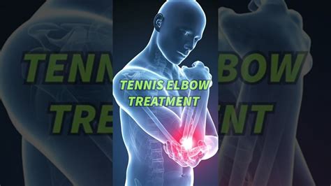 Treating Tennis Elbow Lateral Epicondylitis Youtube