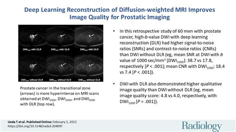 Deep Learning Reconstruction Of Diffusion Weighted Mri Improves Image