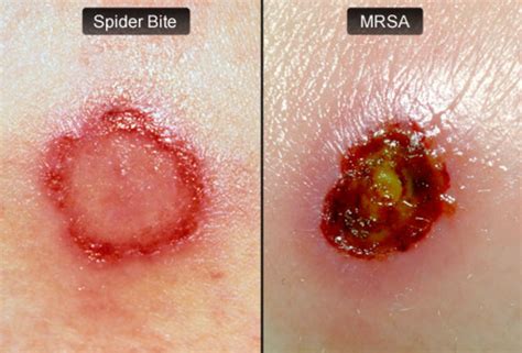 What Is Mrsa Impetigo Signs And Symptoms Treatment Diagnosis And