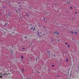 Distinct Stages Of Structural Myocardial Disease In Hfpef A C