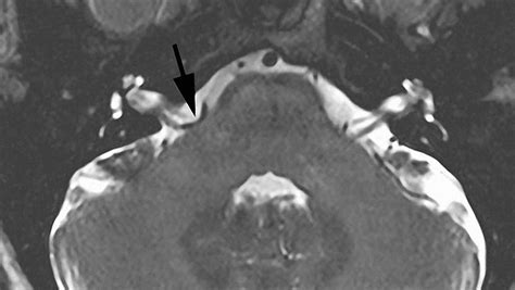 Hemifacial Spasm Treatment Expert Surgeon Aaron Cohen Gadol Md