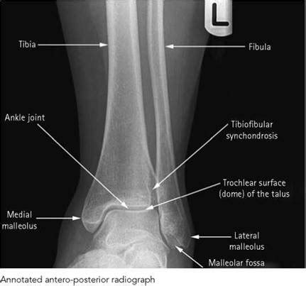 Radiological Anatomy Of The Lower Limb E Anatomy Off