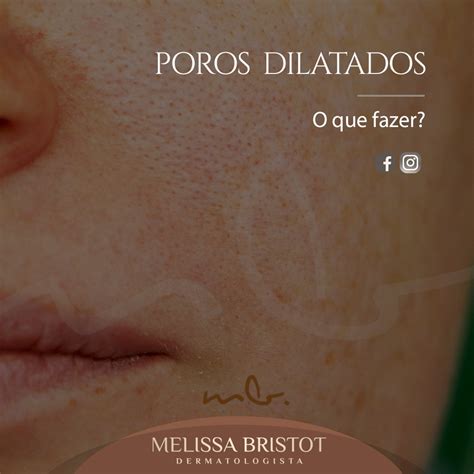 Dra Melissa Bristot Dermatologista Poros Dilatados O Que Fazer