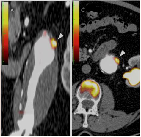 Compose Response Greater Aortic Inflammation And Calcification In