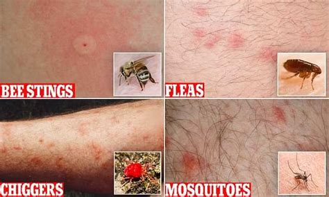 First Aid Expert Reveals Her Ultimate Guide To Common Bites And Stings Bites And Stings