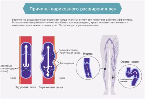 Детралекс: инструкция по применению, цена, аналоги, отзывы и как принимать?