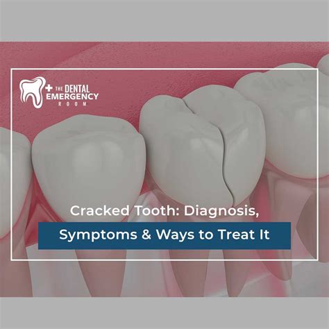 Cracked Tooth: Diagnosis, Symptoms & Ways to Treat It