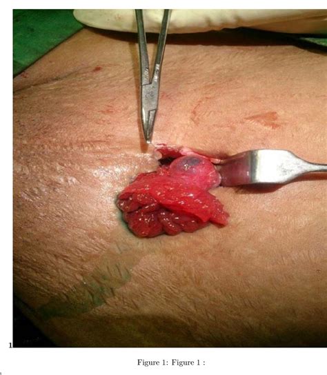 Figure 1 From Tubal Re Anastomoses Through A Mini Laparotomy Incision 1