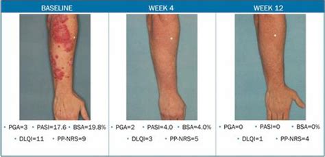 Tapinarof Cream 1 Once Daily For The Treatment Of Plaque Psoriasis