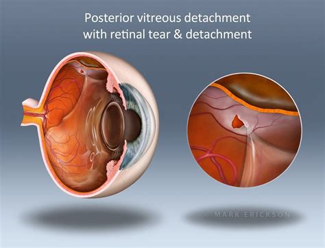 Horseshoe retinal tear, vitreous & rhegmatogenous detachment