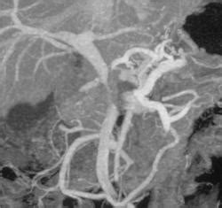 Pancreatic Cancer Invades The Portal Vein With Collaterals Pancreas