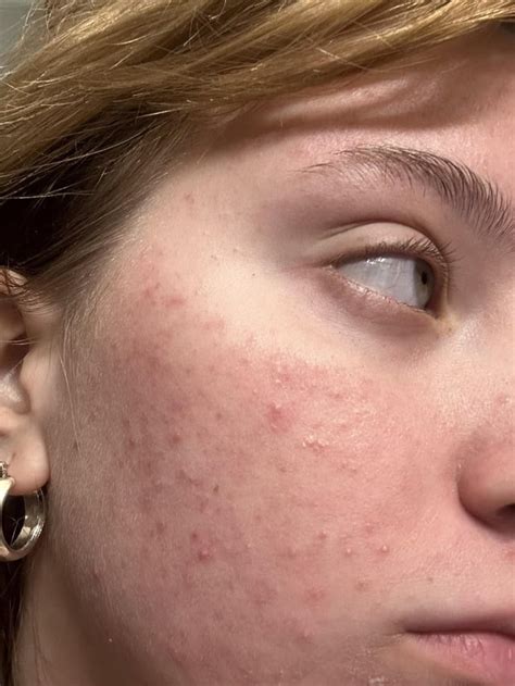 108 Days 40mg 🫢 R Accutane