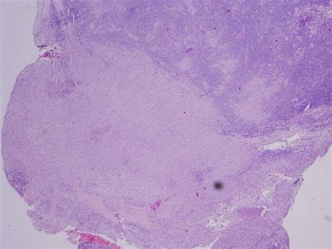 Pathology Outlines Langerhans Cell Histiocytic Neoplasms