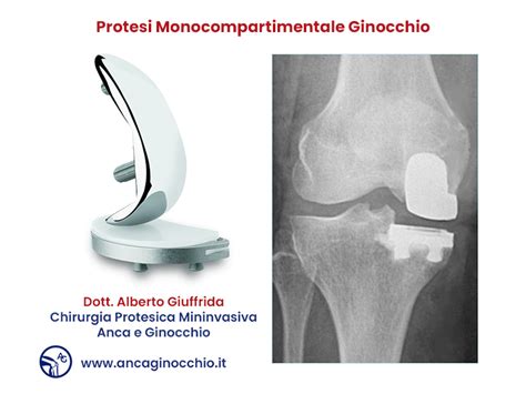 Protesi Monocompartimentale Di Ginocchio Una Soluzione Mininvasiva Per