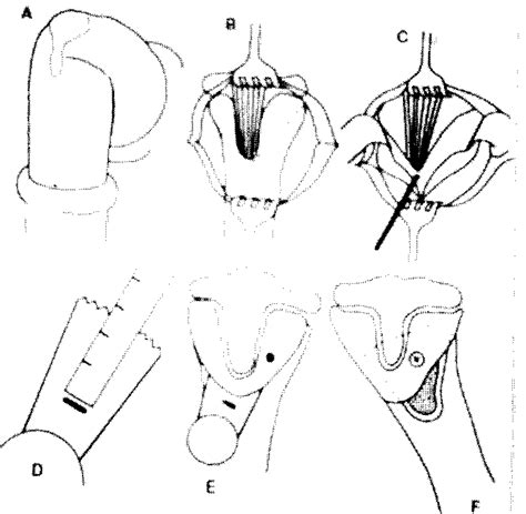 Operative Technique A Transverse Skin Incision B Y Shaped Download Scientific Diagram