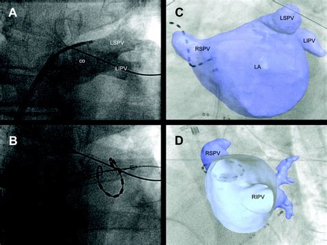 Evaluation Of Pulmonary Vein Stenosis After Pulmonary Vein Isolation