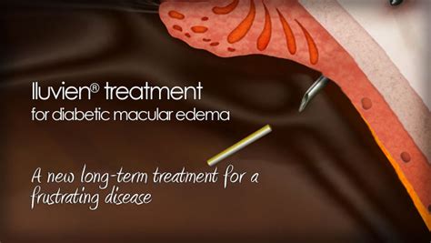 Iluvien treatment for diabetic macular edema