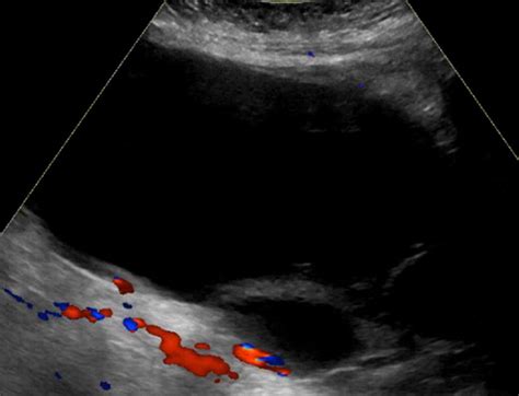 O Rads 3 Ultrasound Image Shows A Multilocular Cyst Measuring 18 0 Cm