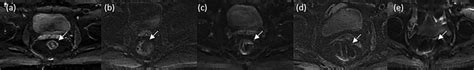 Representative Axial Slices Depicting The Presence And Severity Of