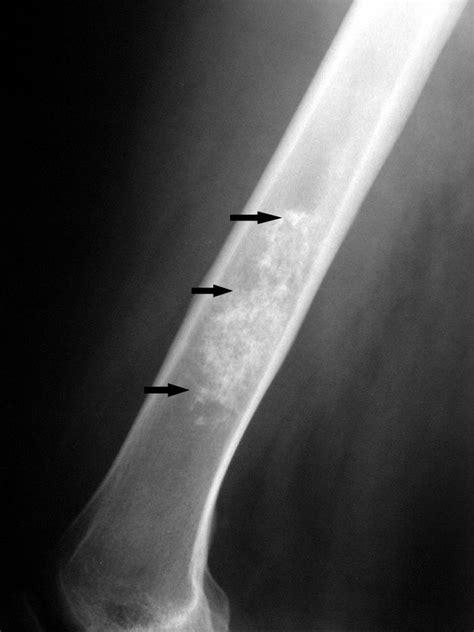Noncancerous Bone Tumors - Bone, Joint, and Muscle Disorders - MSD