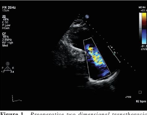 Figure 1 From Three Dimensional Echocardiographic Evaluation Of Severe