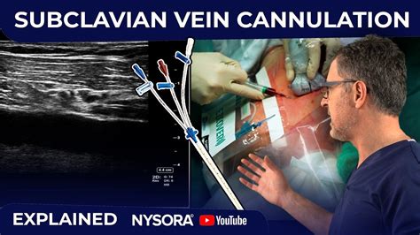 TECHNIQUE OF SUBCLAVIAN LINE AND TRIPLE LUMEN CATHETER INSERTION WITH ...