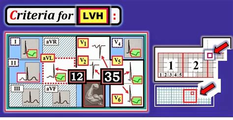 ECG Interpretation: ECG Blog #92 (Basic Concepts-5) – LVH