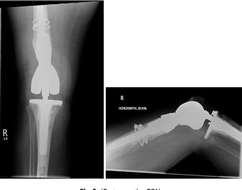 Figure 2 From Management Of Periprosthetic Distal Femur Fractures Using Distal Femoral