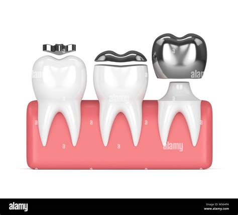 D Render Of Teeth With Inlay Onlay And Crown Amalgam Filling Over