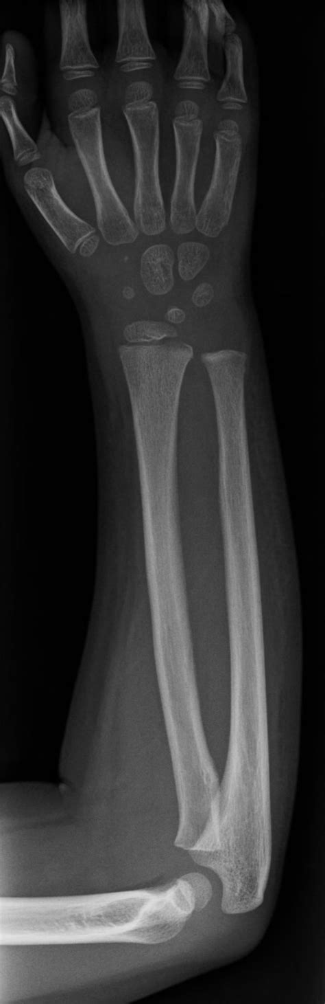 Radial Osteomyelitis Image Radiopaedia Org