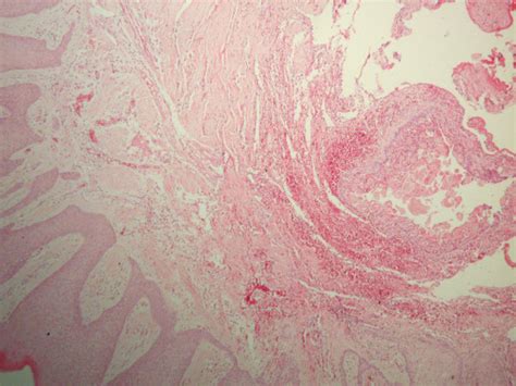 Hematoxylineosin Stained Section Of A Well Circumscribed Cystic Lesion