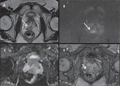 Scielo Brasil Bcg Instillations Can Mimic Prostate Cancer On