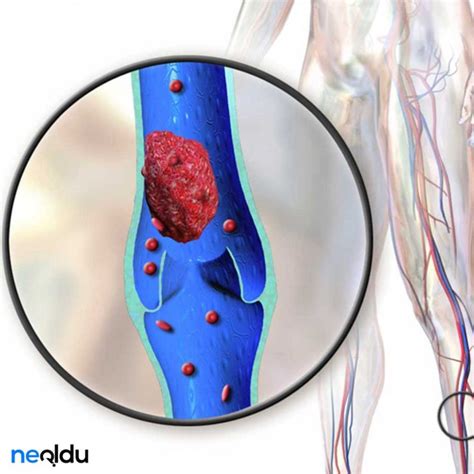 Derin Ven Trombozu Te Hisi Ve Tedavi Y Ntemleri