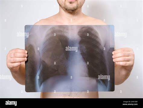 Healthy lungs x ray hi-res stock photography and images - Alamy