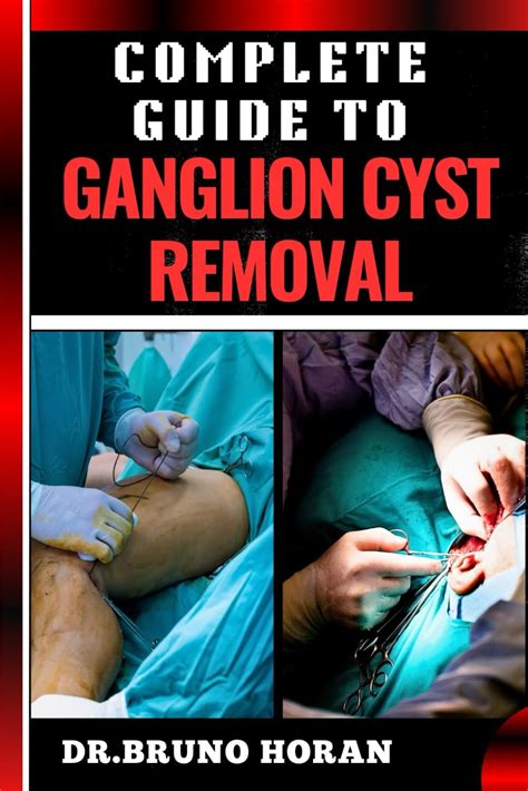 Complete Guide To Ganglion Cyst Removal Comprehensive Handbook To