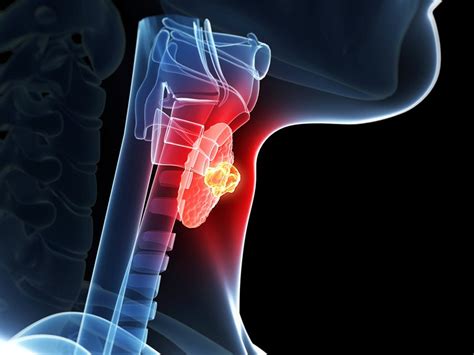 Increased Screening: Rise In Thyroid Cancer Misdiagnosis