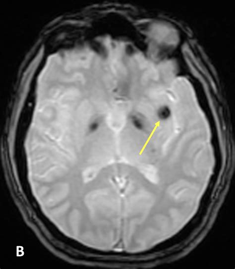 Cavernous Malformation CM MRI Online Is Now Medality