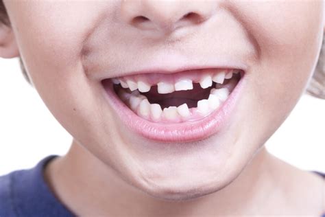 Denti Storti Bambini Cause E Rimedi Wedental Care