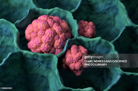 Lung Cancer Cells Illustration High-Res Vector Graphic - Getty Images